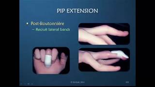 Obstinate PIP Joint: Part 10 of 12: Active Redirection for PIP Joint Extension  (Discussion)