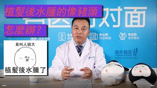 植髮術後出現水腫怎麼辦？會影響植髮效果嗎？Yonghe hair transplant