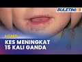 HFMD | Peningkatan 15 Kali Ganda