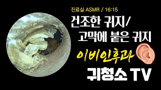 건조한 귀지제거 / 고막에 붙은 귀지 (ear wax removal)