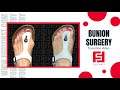 Cosmetic Bunion Surgery with the Sklar Bunionectomy®