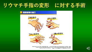 リウマチ手指変形の代表的な手術　～当院での手術例を中心に～　＃シリコンインプラント　＃滑膜切除　＃関節形成術