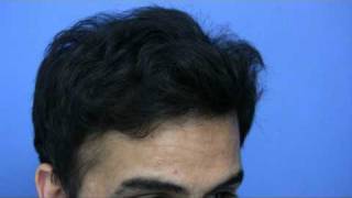 Hair Transplant by Dr Hasson - 4200 Grafts - 1 Session