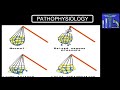 PULMONARY EDEMA