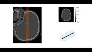 Automatic Exposure Control in Head CT Imaging