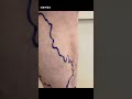 perforator reflux varicose veins chiva treatment. 静脉曲张 varicoseveinstreatment