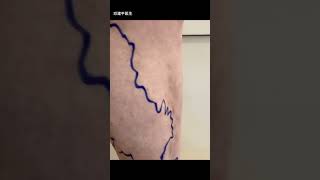 Perforator reflux varicose veins CHIVA treatment. #静脉曲张 #varicoseveinstreatment