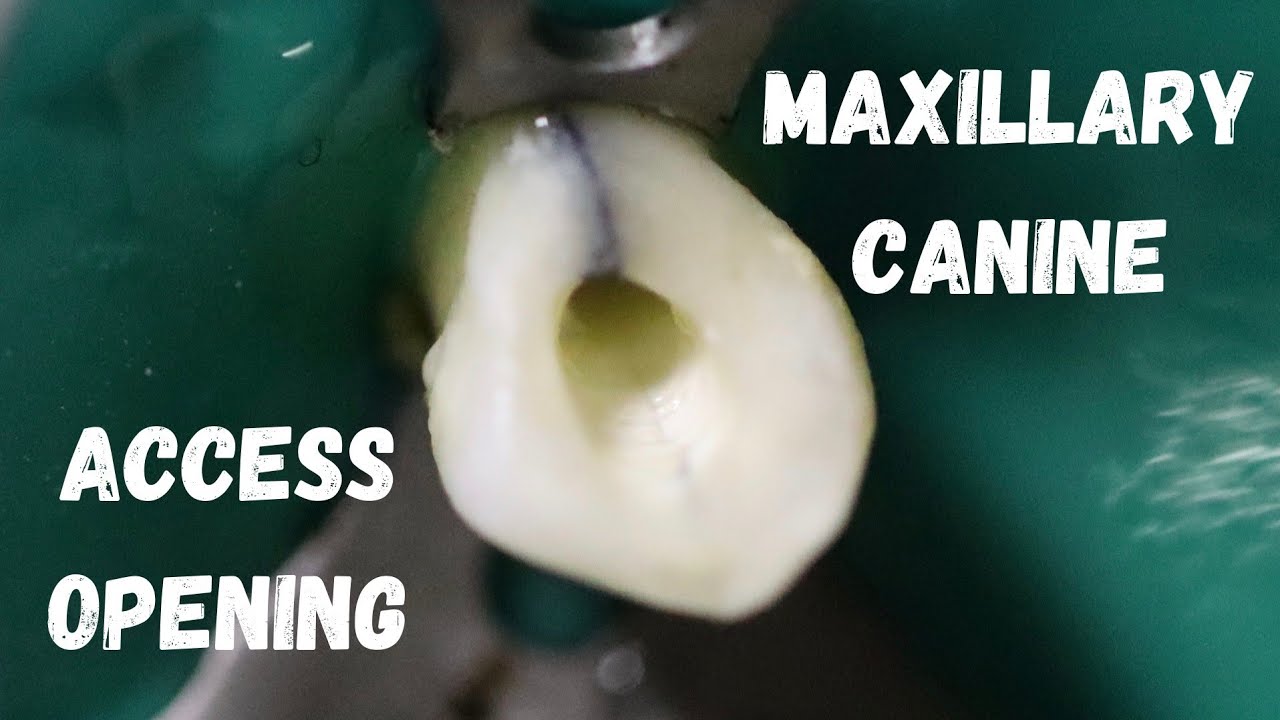 Access Opening Of Maxillary Canine | Simulated Demonstration | Step By ...