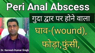 Know more about PeriAnal Abscess,मल द्वार पर होने वाला घाव, फोड़ा, फुंसी, मवाद बहना, के बारे में