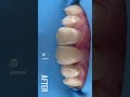 #composite #internalbleaching #dentistry #dentist