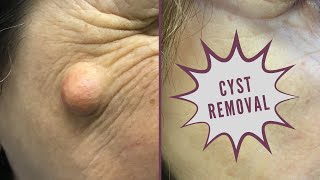 Cyst Removal on Cheek - Before and After Photos