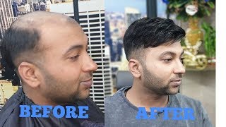 BEFORE & AFTER A non surgical hair tapping system  in delhi  9582581323,,8882017181
