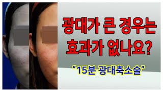 광대가 큰 경우는 효과가 없나요?? - 퀵광대 방식의 변형15분 광대축소술 feat.전후사진