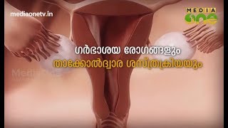 Stethoscope | ഗർഭാശയ രോഗങ്ങളും താക്കോൽദ്വാര ശസ്ത്രക്രിയയും | Episode 230