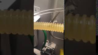 Live video Gallstones removal during a colonic irrigation at Feel The Heal Miami