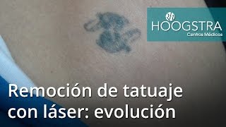 Remoción de tatuaje con láser: evolución (16103)