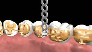 Incognito™ Appliance System Clinical Guide 06: Lasso Elastic (Conventional Lasso)