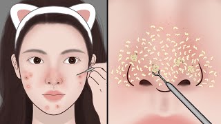 Satisfying Relaxation~ ASMR Blackhead Removal, Blackhead extraction | Meng's Stop Motion