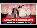 Dental Implants & Bone Grafting after Tooth Extractions