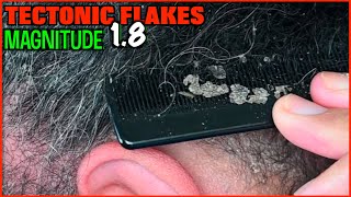 TECTONIC FLAKES MONTAGE (MAGNITUDE 1.8) | DANDRUFF ON SCALP | SEBORRHEIC DERMATITIS | PitaFlakes