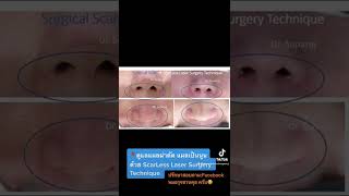 รักษาแผลผ่าตัด แผลเป็นนูนด้วย ScarLess Laser Surgery Technique หมอรุจชวนคุย รักษาคีลอยด์