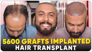 Hair Transplant in Gurugram | Best Results & Cost of Hair Transplant in Gurugram