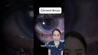 ใครมีวงขาวๆที่ขอบตาดำบ้าง #หมอกิ๊ก #จักษุแพทย์ #ophthalmologist #cornealarcus #ไขมันในเลือดสูง #ตา