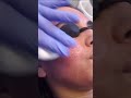 rosa s acne scar journey continues with sublative laser