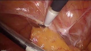 Abscess excision of Vaginal stump and appendectomy Safe Laparoscopy