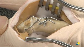 Index Finger - Destroyed Proximal Interphalangeal Joint - Arthrodesis of the Joint, and Fixation