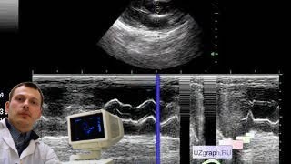Лекция: Эхокардиография (УЗИ сердца). Базовый уровень.