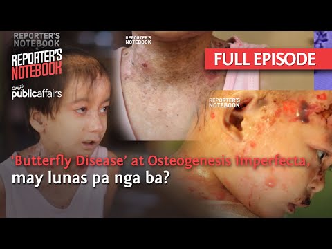 ‘Butterfly Disease’ at Osteogenesis Imperfecta, may lunas ba? (Full Episode) | Reporter’s Notebook