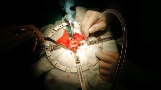 Холецистэктомия из мини-доступа / Mini-laparotomy Cholecystectomy