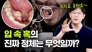 입안의 혹, 골융기 꼭 제거해야 할까?| 골융기의 모든 것 알려드립니다