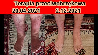 Obrzęk nógi żylne i limfatyczne - objawy, terapia i efekt zdrowotny