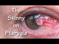 The Skinny on Pterygia