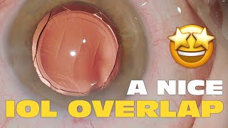 Phaco Clip #182 - A Nice IOL Overlap!