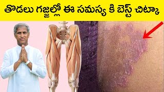 తొడలు గజ్జల్లో ఈ సమస్య కి బెస్ట్ చిట్కా | Thigh Problems | Dr Manthena Satyanarayana Raju Videos