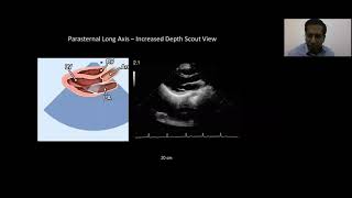 Philips Echo Webinar Series Image Aquisition Protocol Dr  Jesu Krupa, CMC Vellore