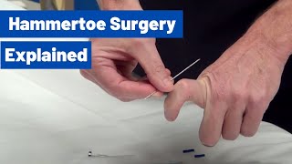 Hammertoe Surgery Explained by Dr. Moore (Using an 'Internal Pin')