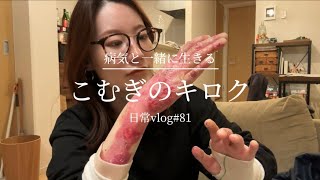 【表皮水疱症】最近手の皮膚の縮みに困ってます 日常vlog#81