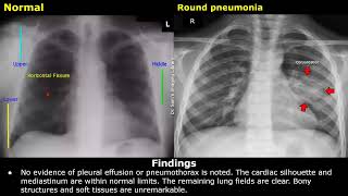 Chest X-Ray Pneumonia Reporting | How To Write CXR Reports | Clinical History, Findings \u0026 Impression