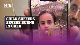 Israeli bombing leaves child with severe burns to her face and body