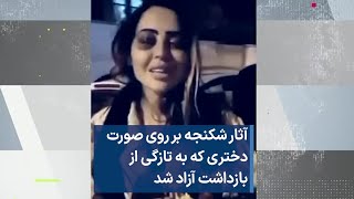 آثار شکنجه بر روی صورت دختری که به تازگی از بازداشت آزاد شد