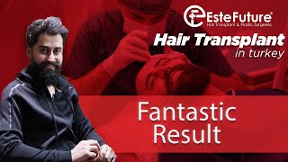 Hair transplant - EsteFuture - Turkey