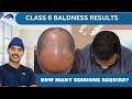 Hair Transplant In Chennai | Best Surgeon Cost Clinic & Results Of Hair Transplant Of Chennai