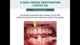 [Zen Dental] Case Study: E-MAX Crown Restoration (Tooth #8)