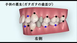 子供のデコボコ歯並び（子供の叢生）｜インビザライン（マウスピース矯正）の矯正治療イメージ（iTeroシュミレート）