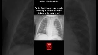 Chest X-ray Question 42