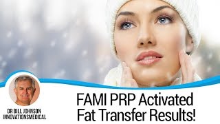 FAMI PRP Activated Fat Transfer Results! - Face